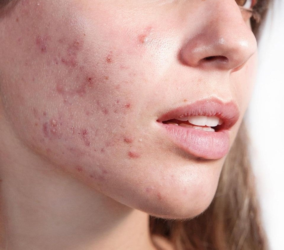 How to Get Rid of Pimples & Acne on Oily Skin: A Simple Routine for Pakistan