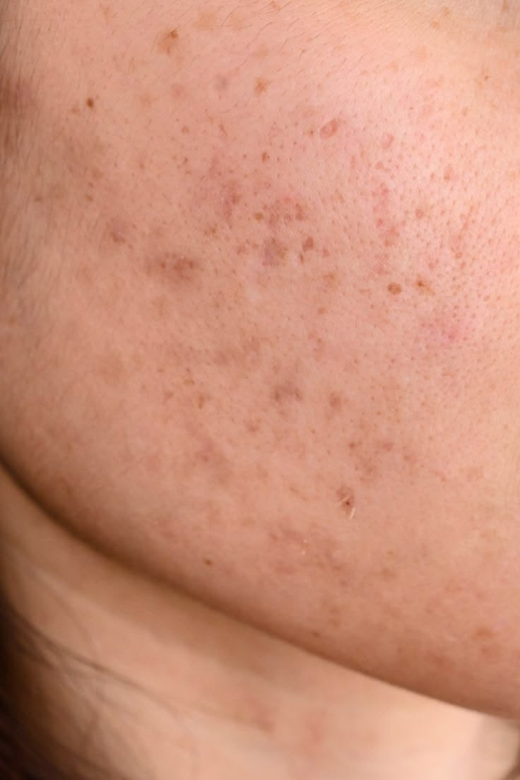 How to Get Rid of Dark Spots & Acne Marks on Brown Skin